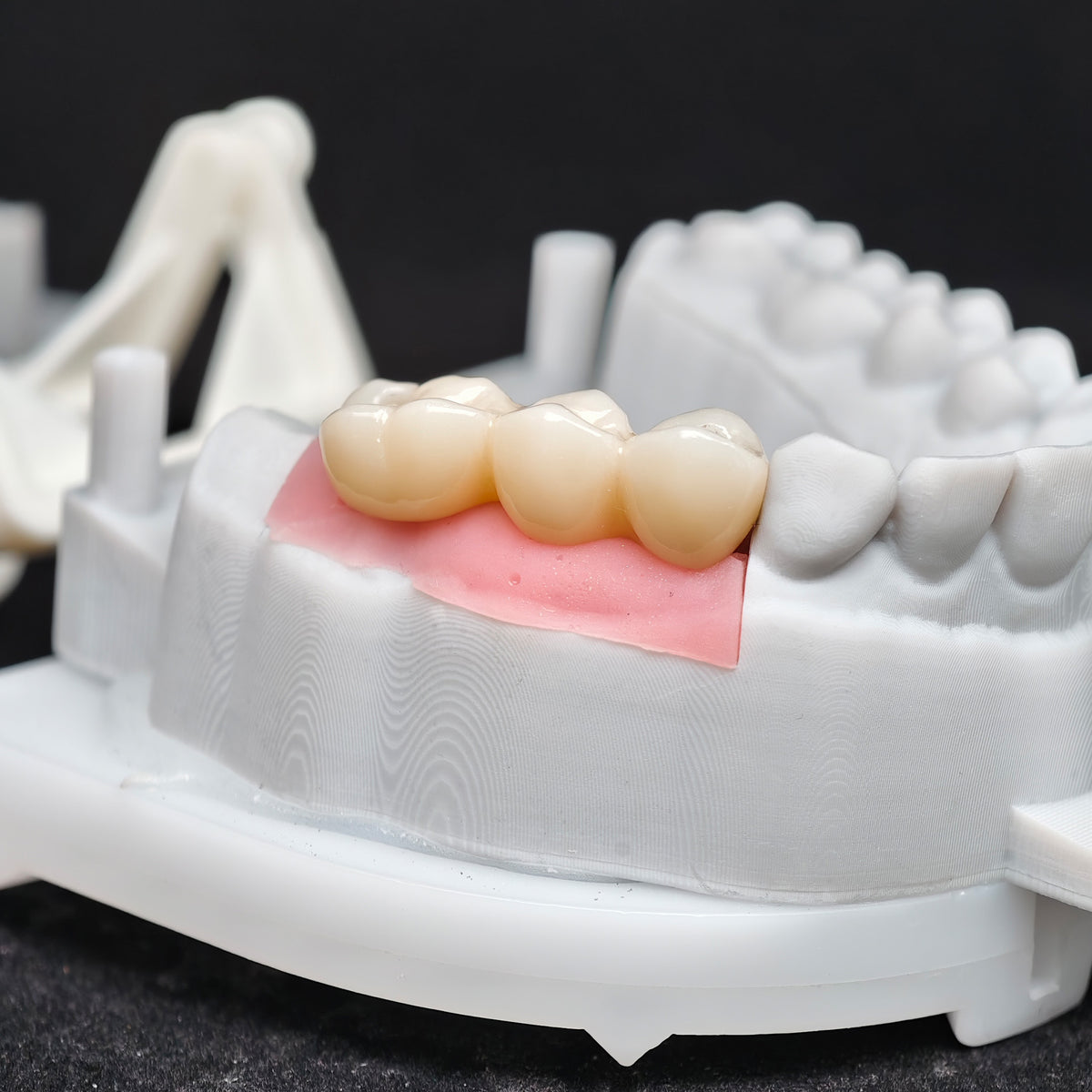 Custom Zirconia Implant Bridge