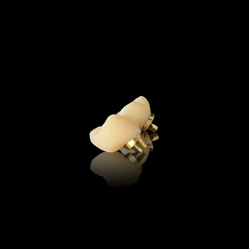 Custom Zirconia Implant Bridge