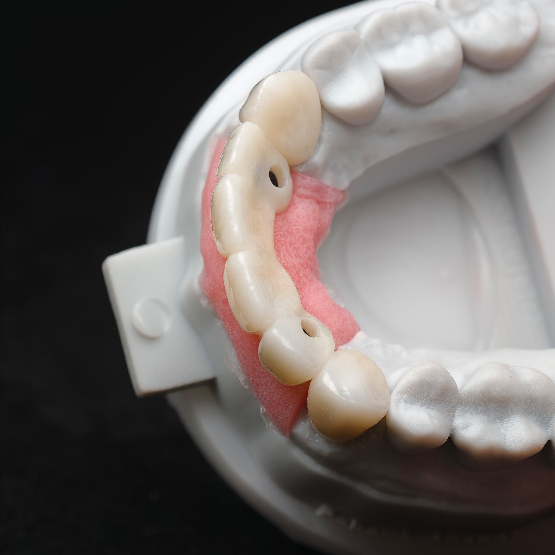 Custom Zirconia Implant Bridge