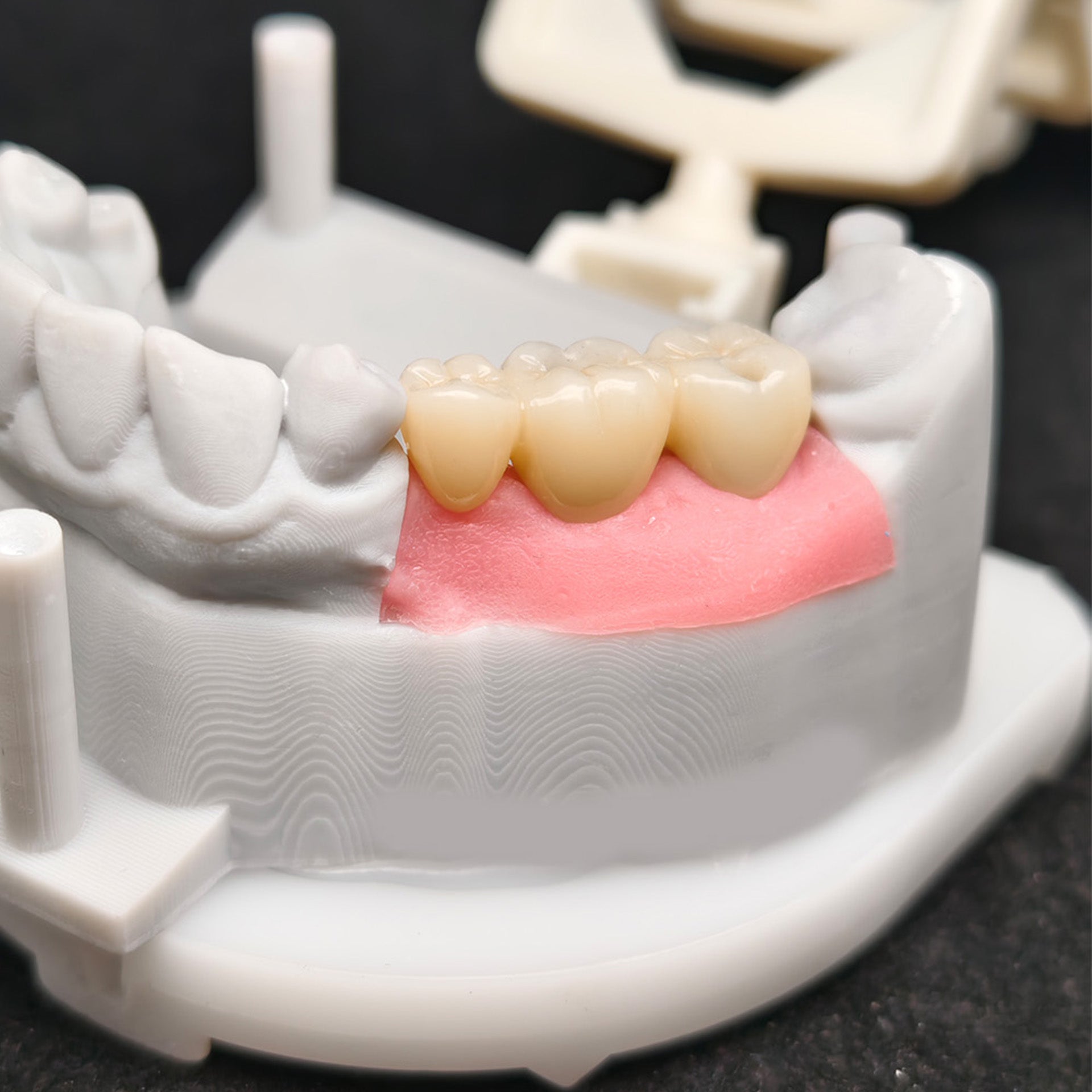 Custom Zirconia Implant Bridge