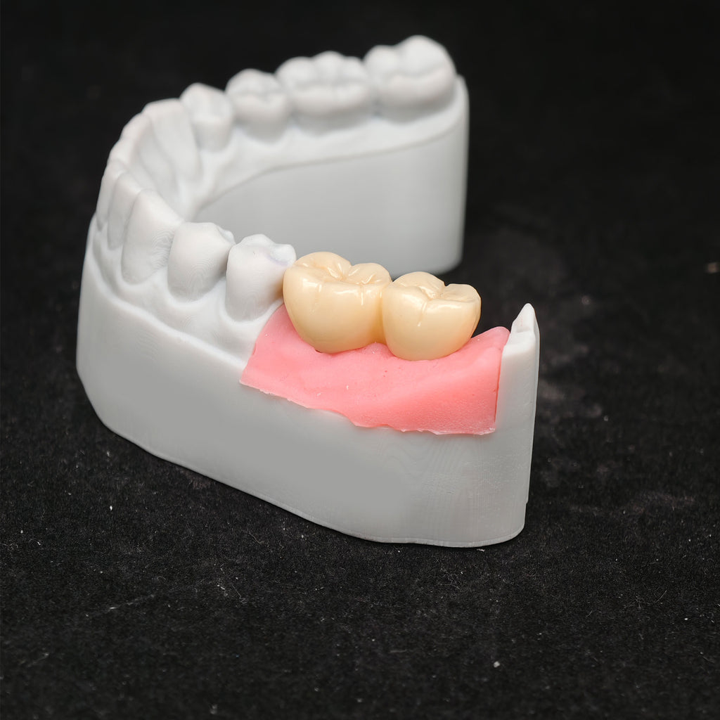 Custom Zirconia Implant Bridge