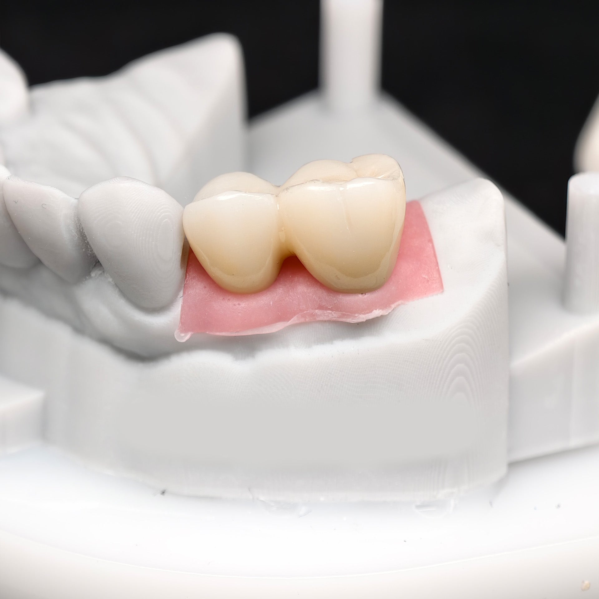 Custom Zirconia Implant Bridge
