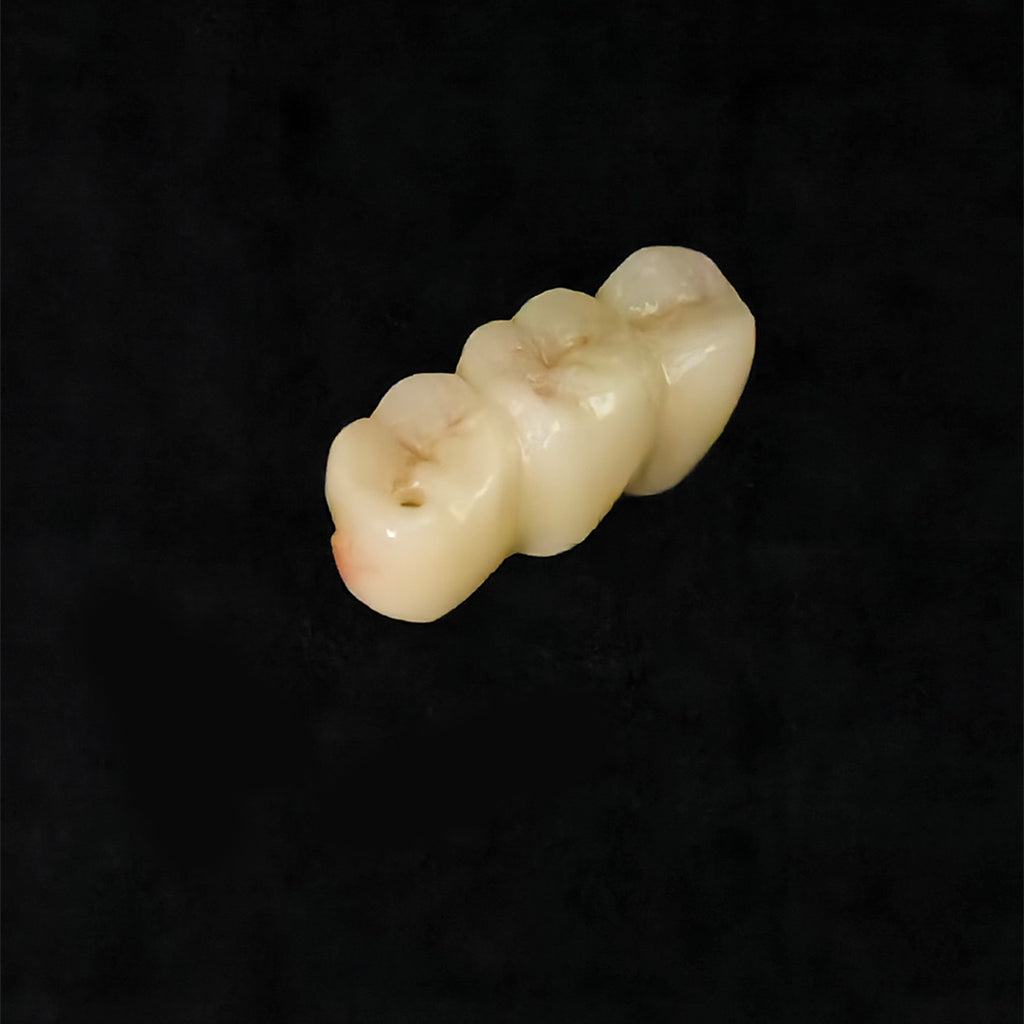 Custom Zirconia Implant Bridge