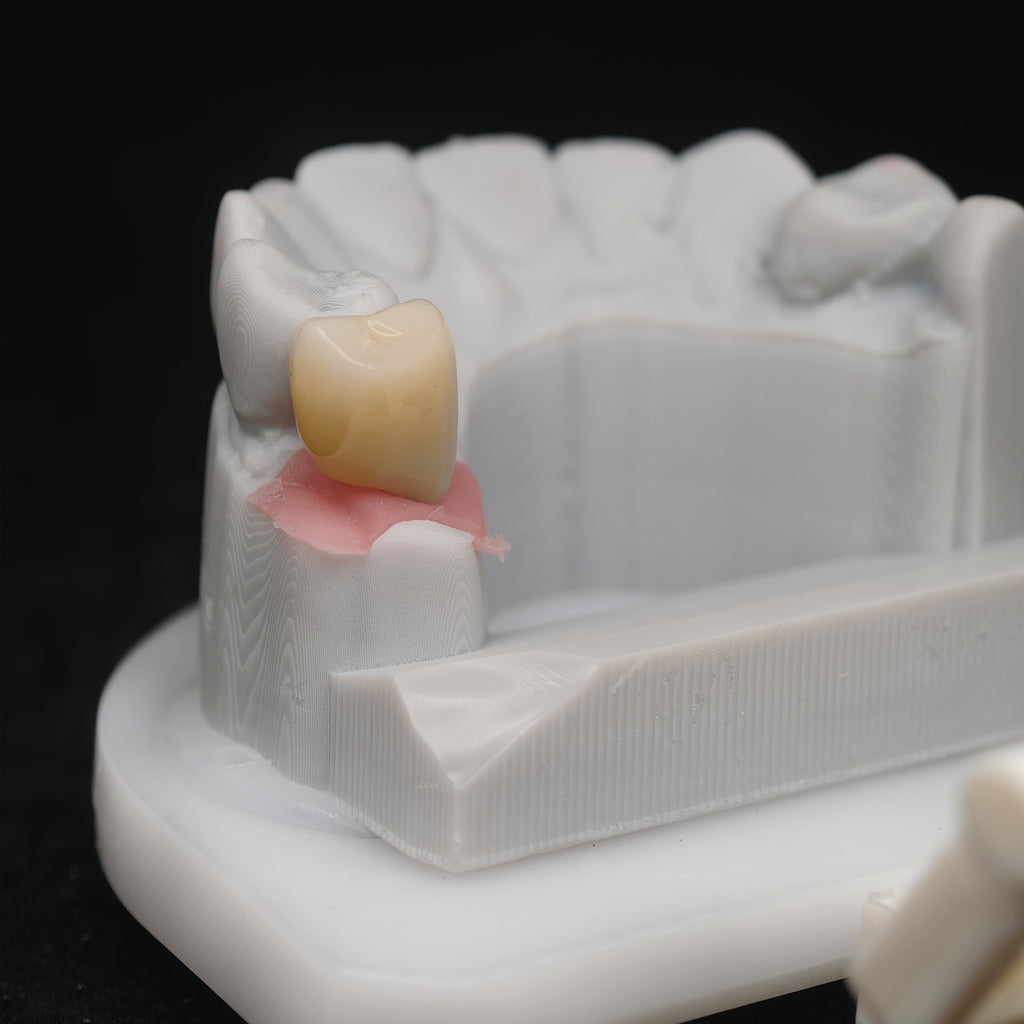 Custom Zirconia Implant Crown
