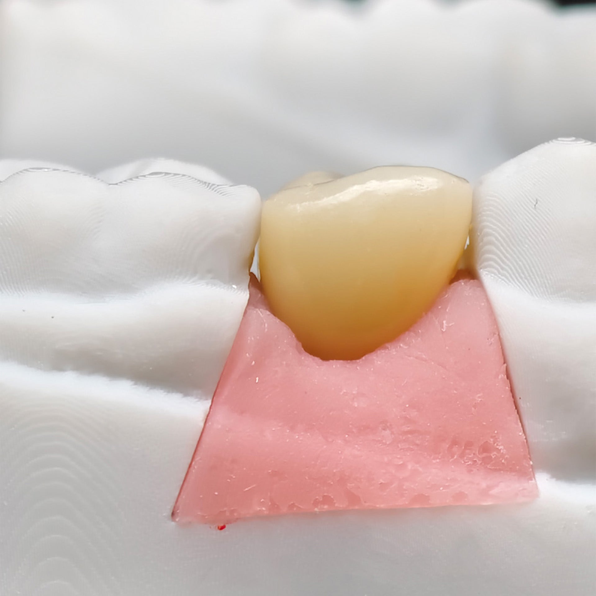Custom Zirconia Implant Crown