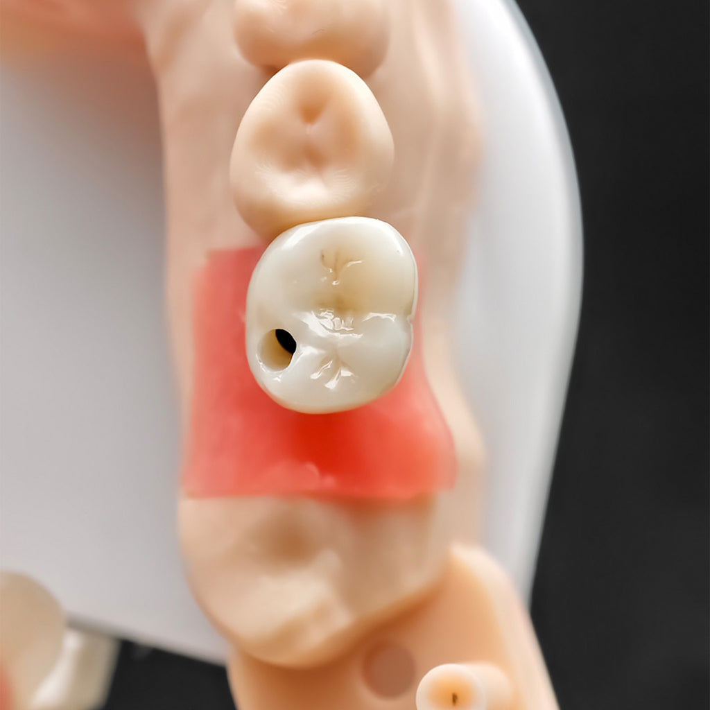 Custom Zirconia Implant Crown