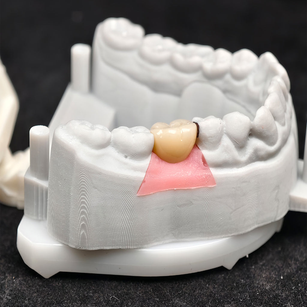 Custom Zirconia Implant Crown