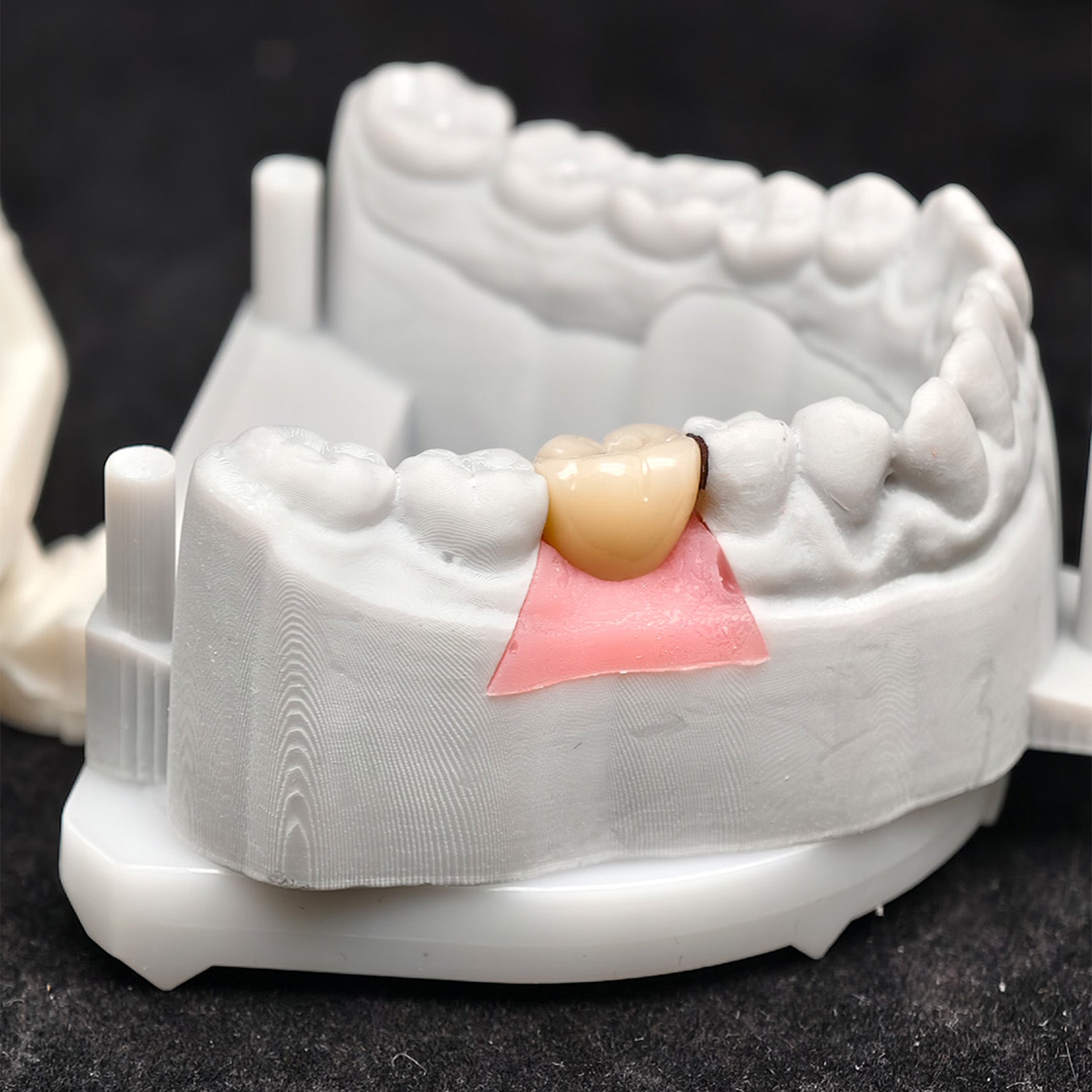 Custom Zirconia Implant Crown
