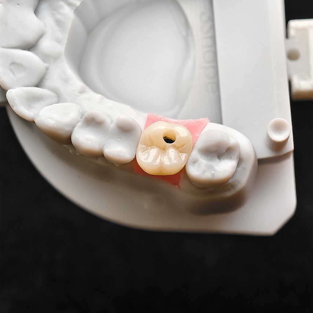 Custom Zirconia Implant Crown