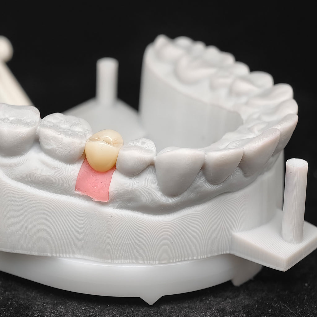 Custom Zirconia Implant Crowns
