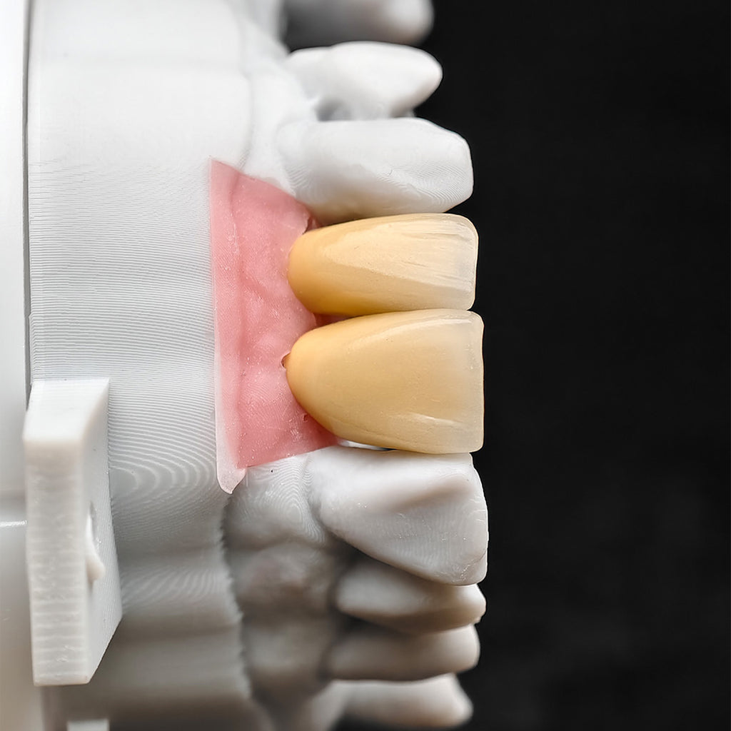 Custom Zirconia Implant Crowns