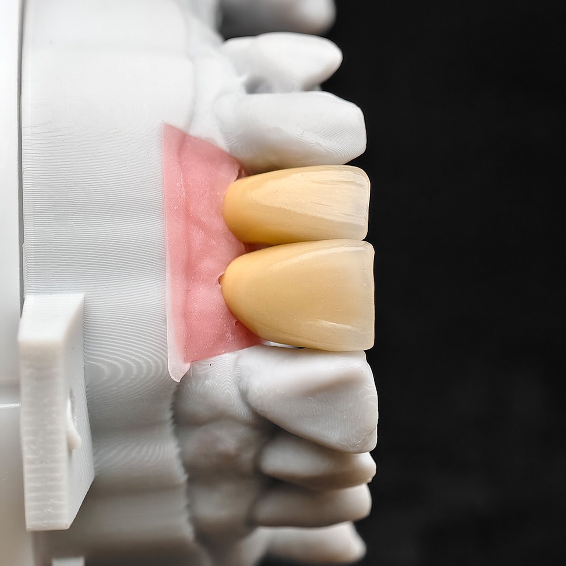 Custom Zirconia Implant Crowns