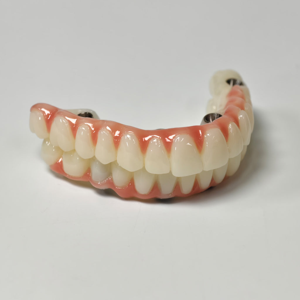 Full-Arch PMMA Bridge With Ti-Base Screw Retained