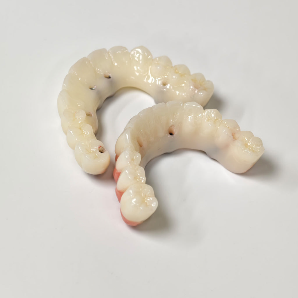 Full-Arch PMMA Bridge With Ti-Base Screw Retained