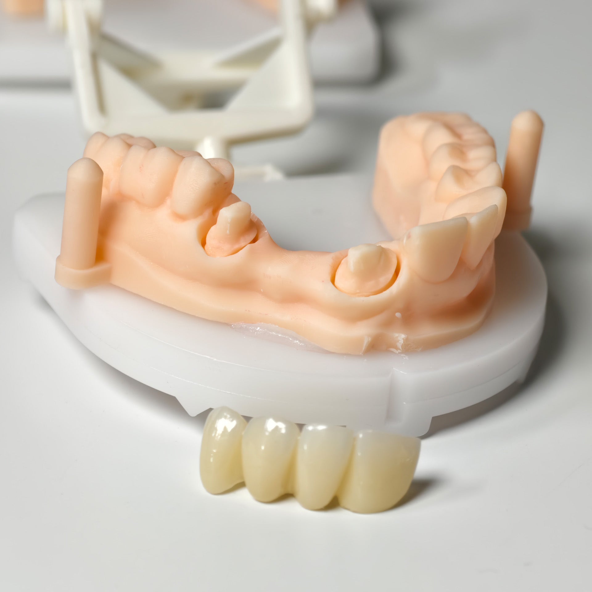 High - Strength Zirconia Bridge