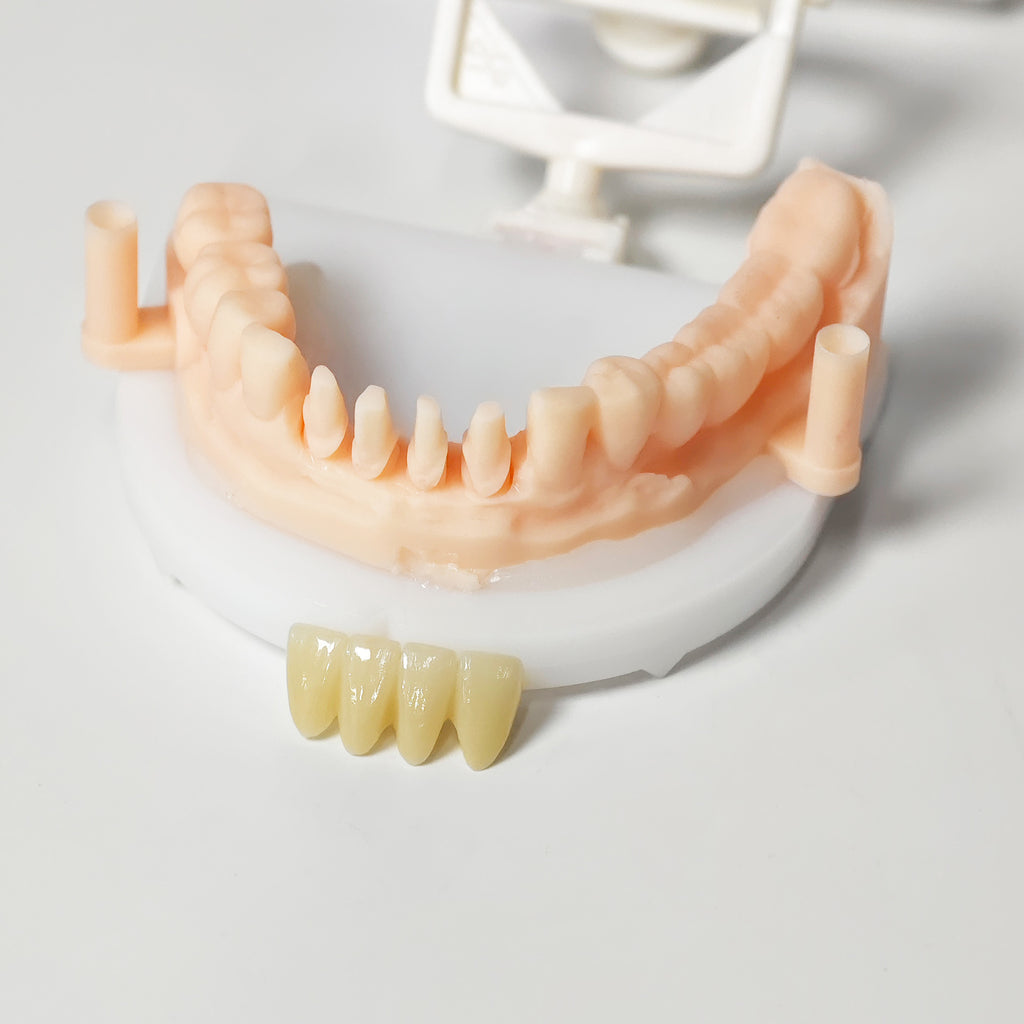 High - Strength Zirconia Bridge