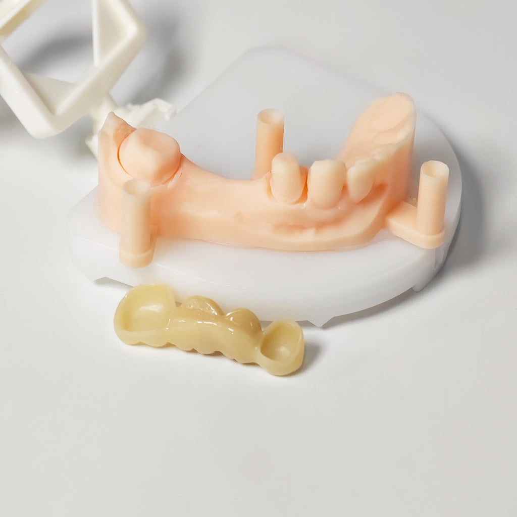 High - Strength Zirconia Bridge
