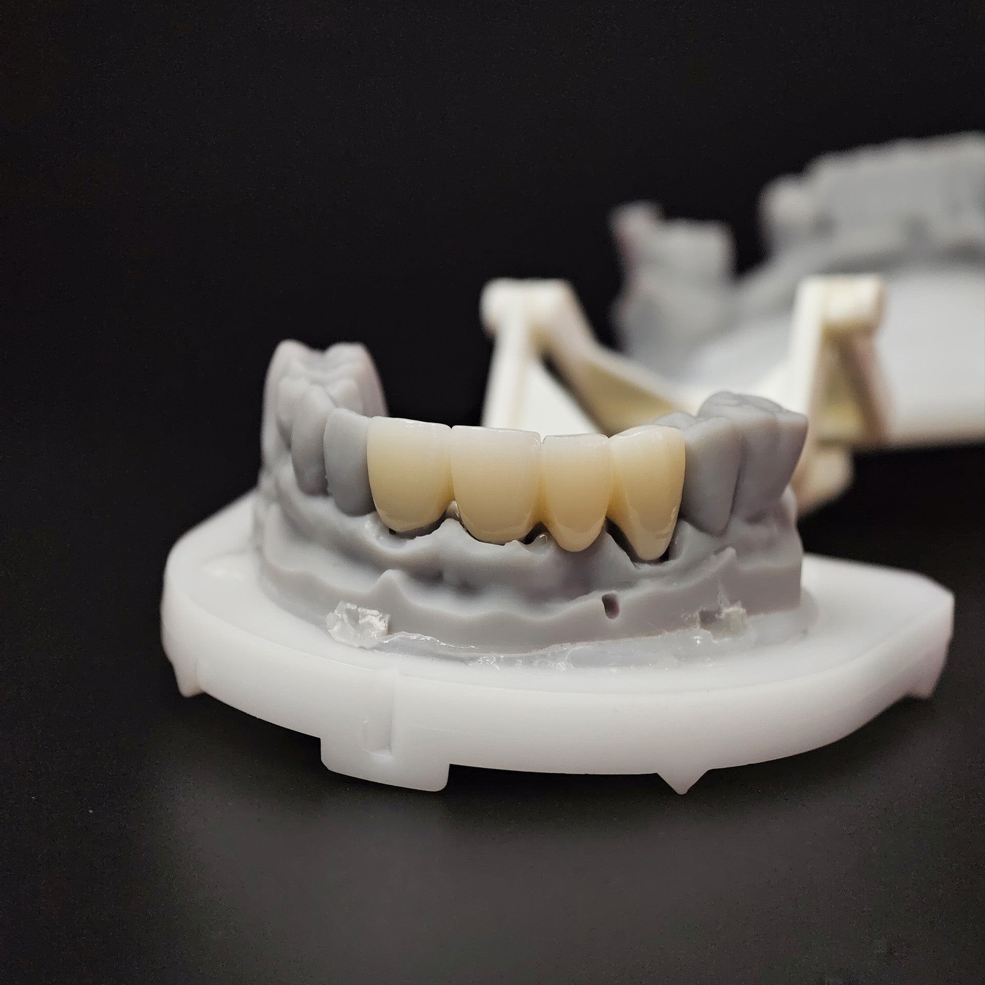 High - Strength Zirconia Bridge
