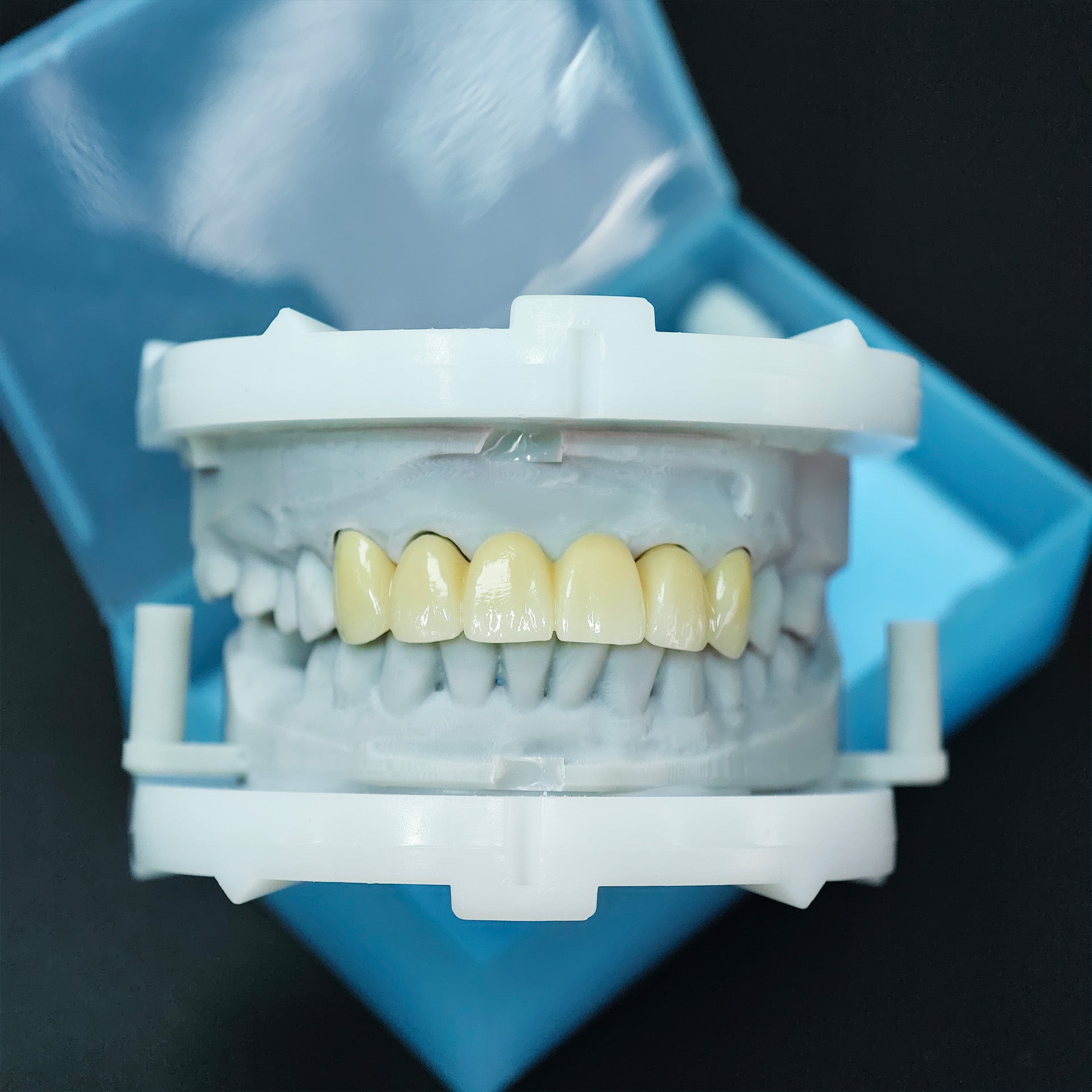 High - Strength Zirconia Bridge