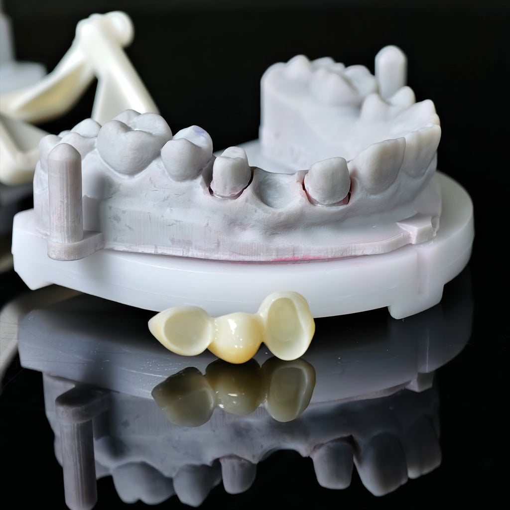 High - Strength Zirconia Bridge