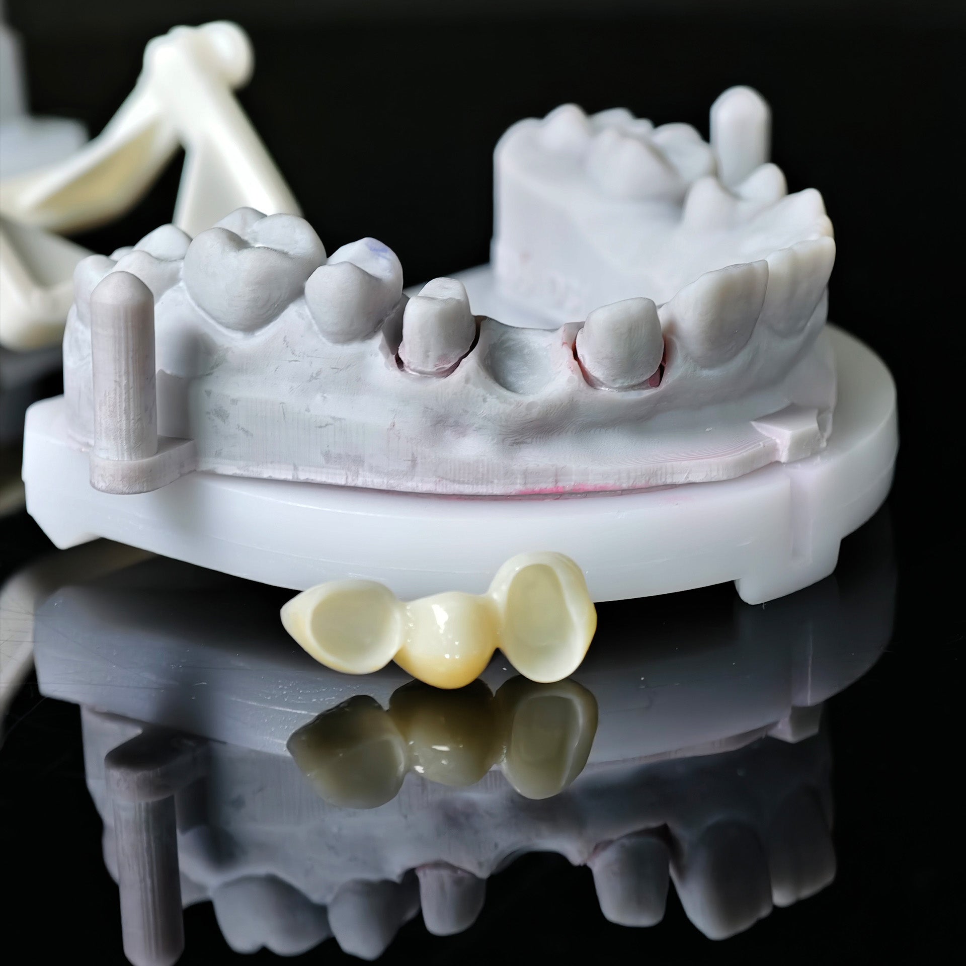 High - Strength Zirconia Bridge