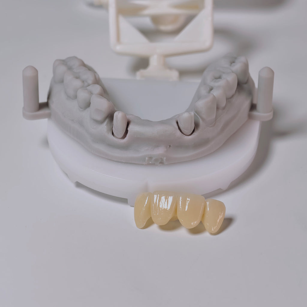 High - Strength Zirconia Bridge
