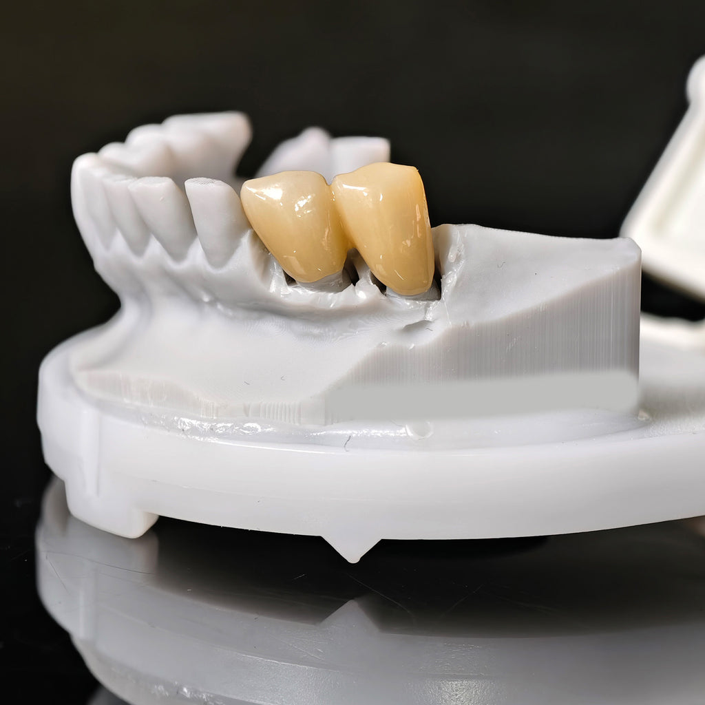 High - Strength Zirconia Bridge