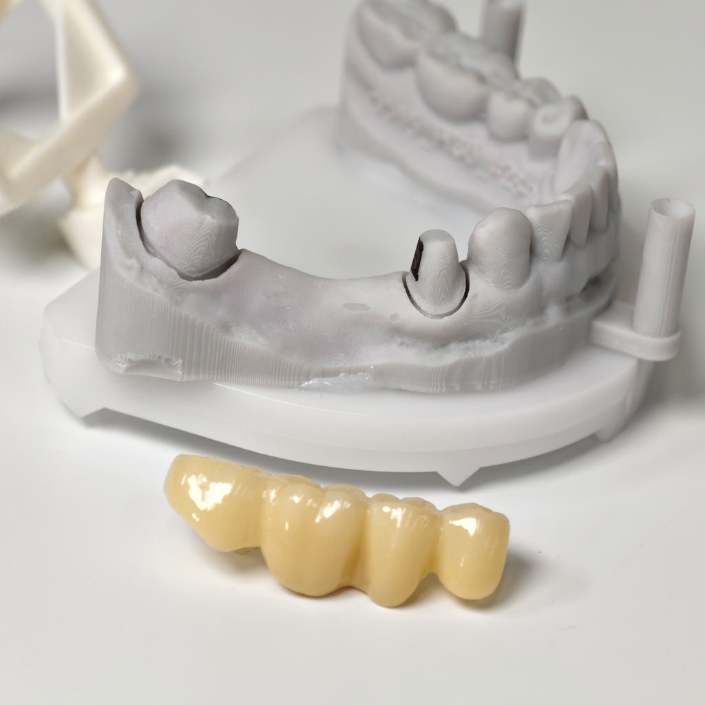 High - Strength Zirconia Bridge