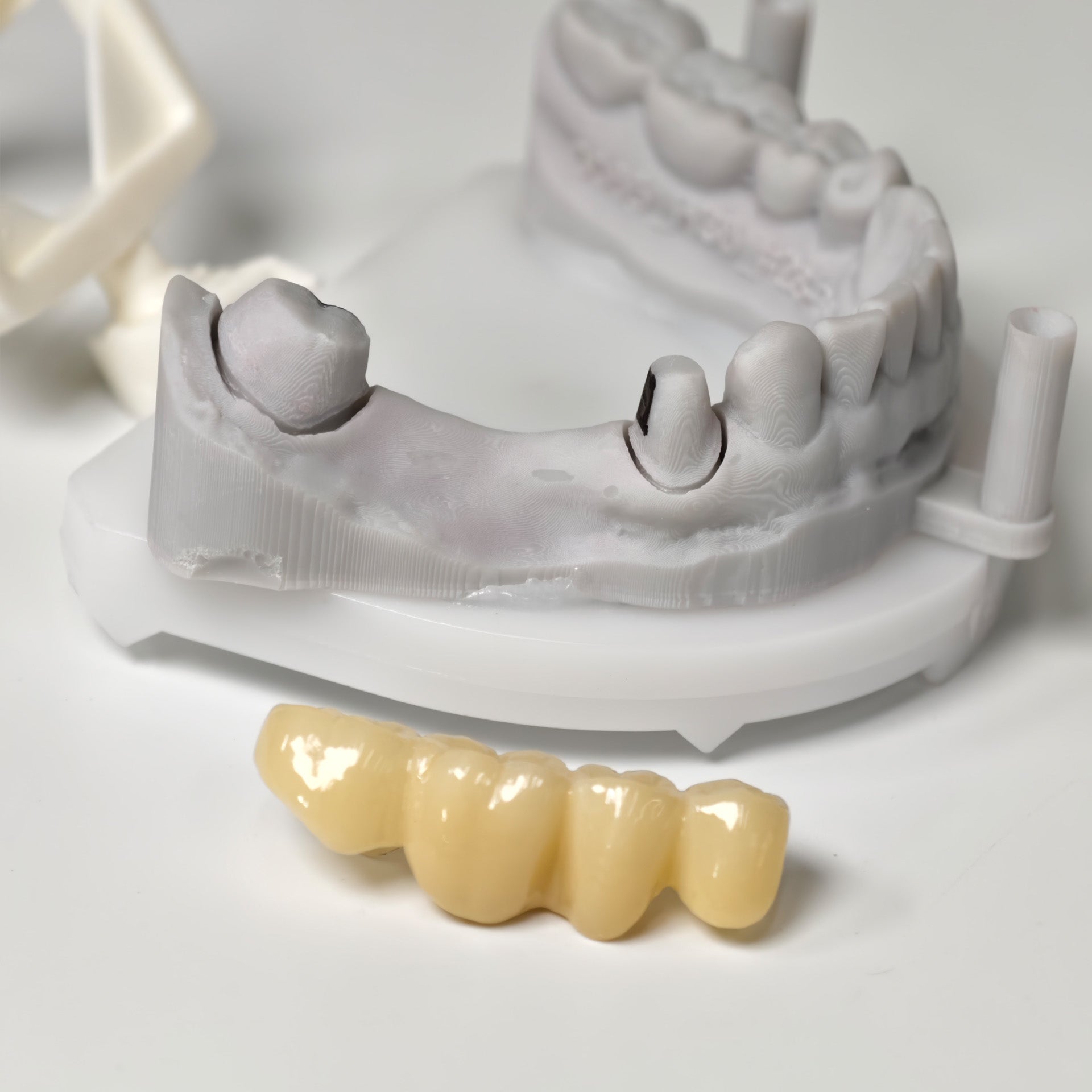 High - Strength Zirconia Bridge