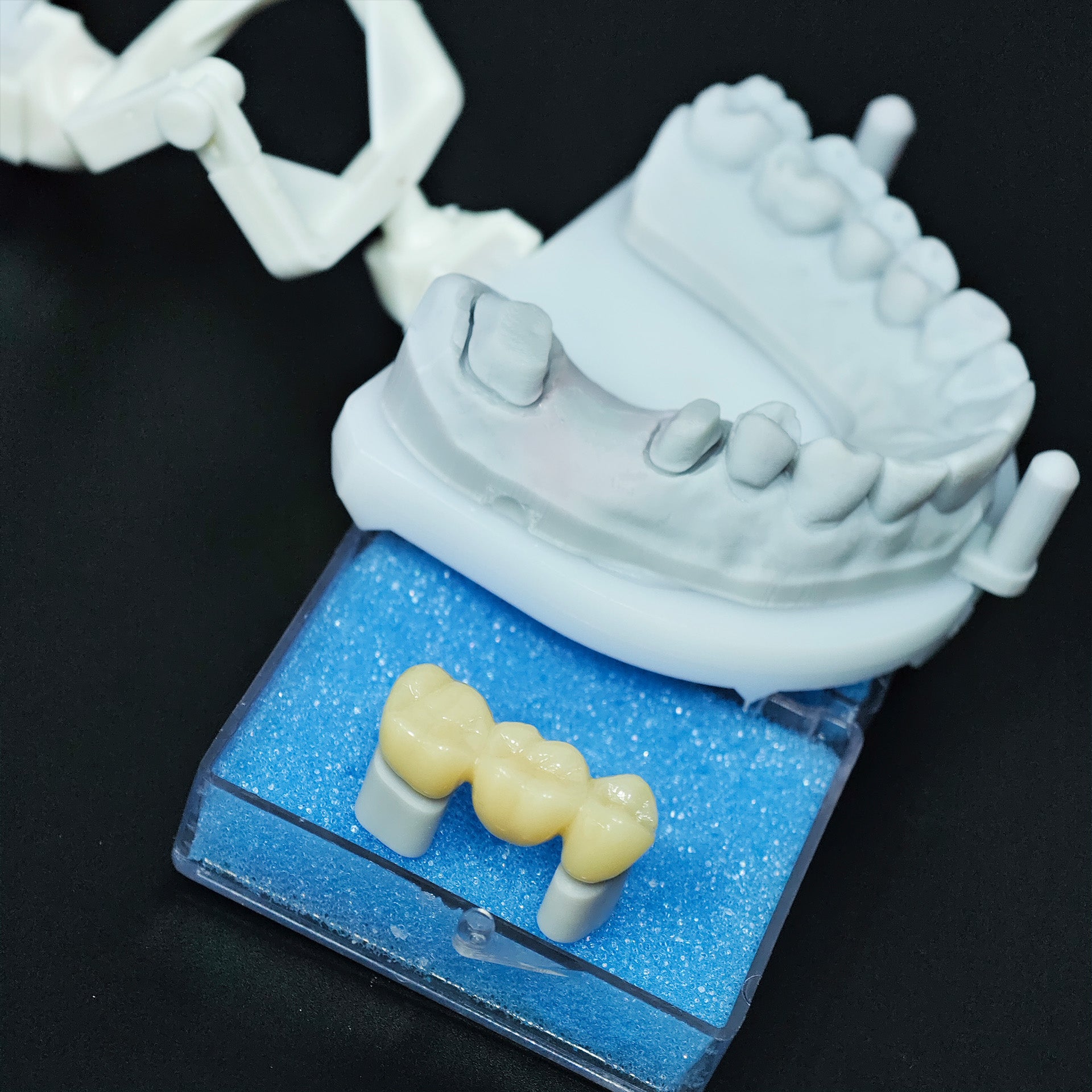 High - Strength Zirconia Bridge