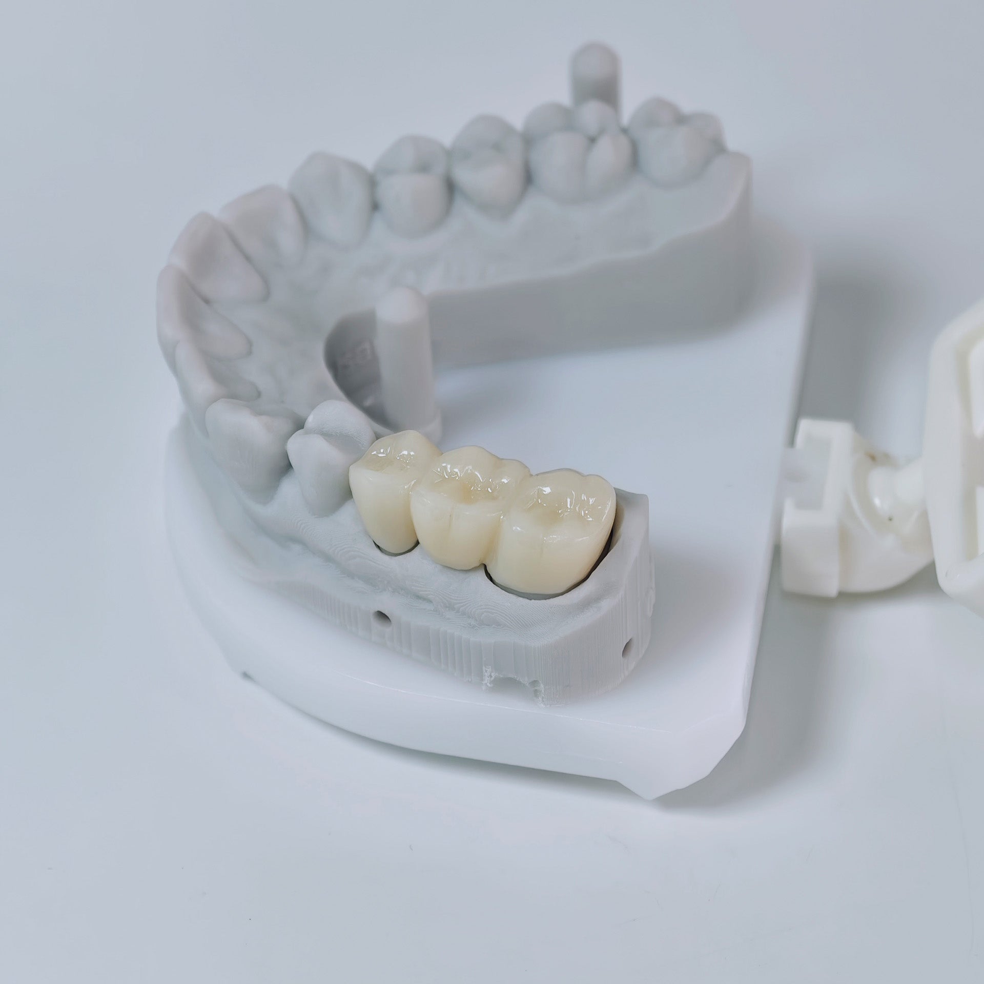 High - Strength Zirconia Bridge