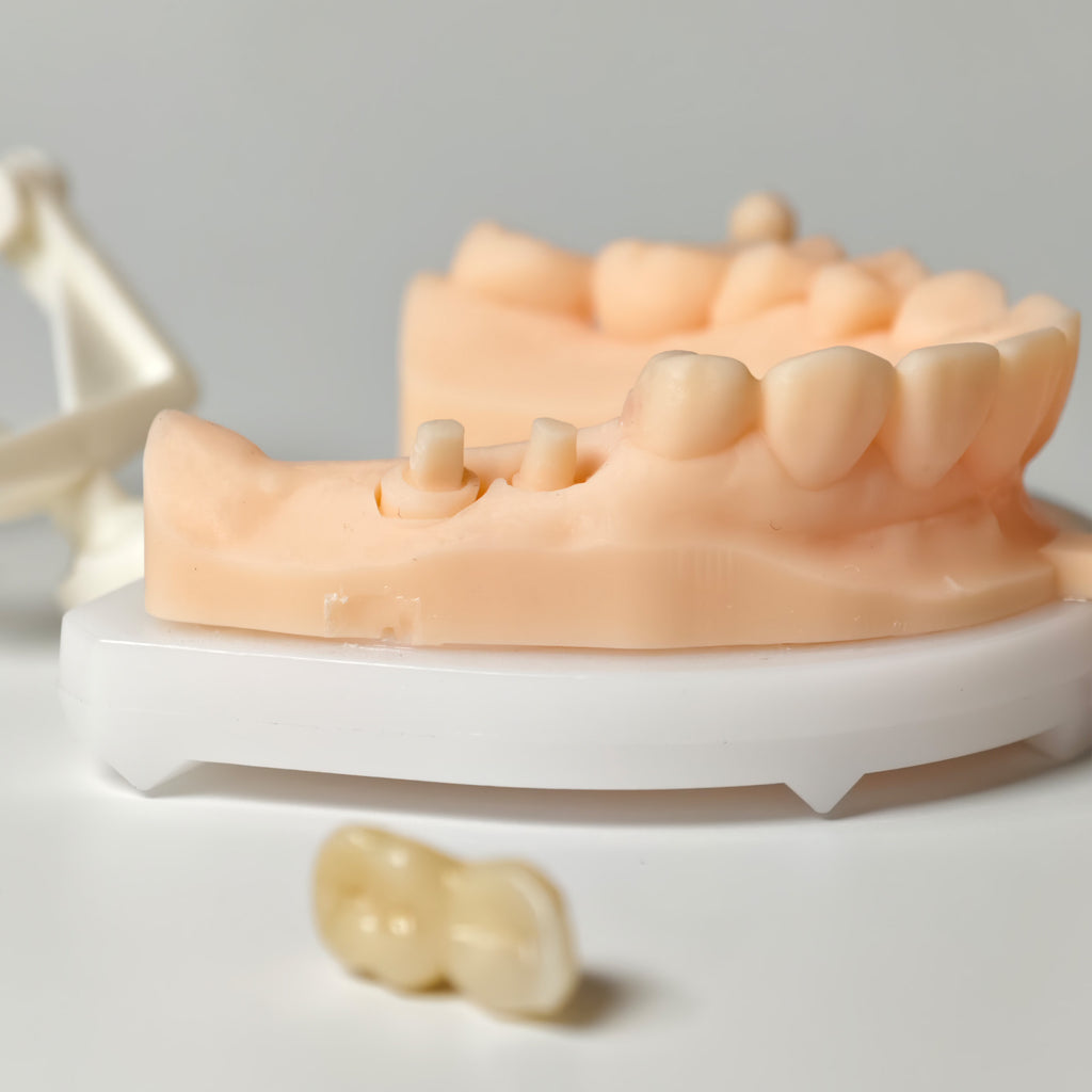 High - Strength Zirconia Bridge
