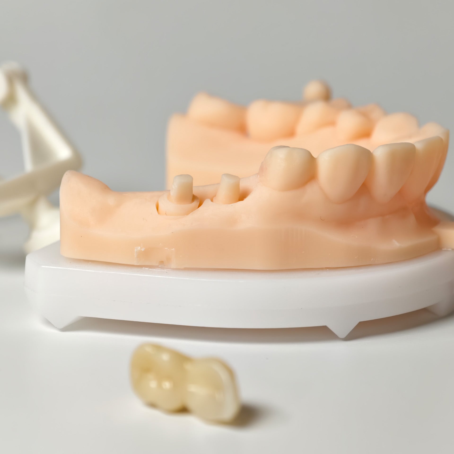 High - Strength Zirconia Bridge