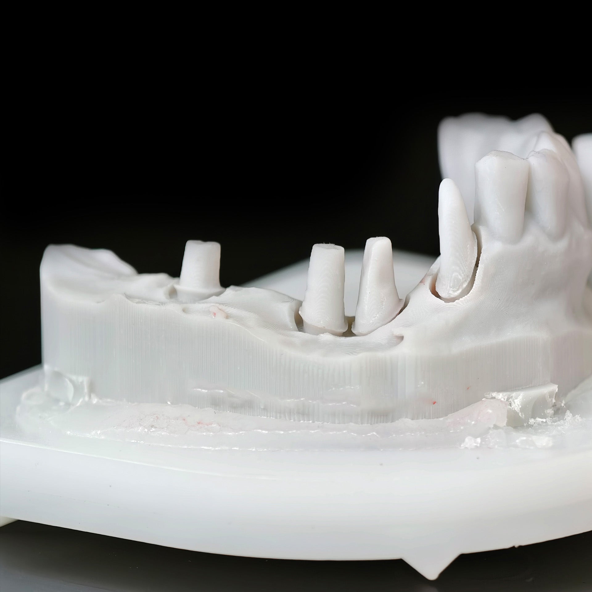 High - Strength Zirconia Crown And Bridge