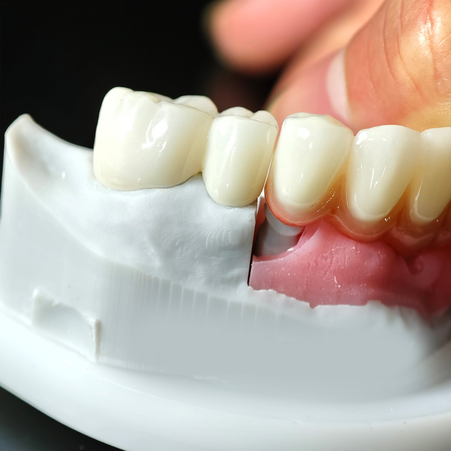 High - Strength Zirconia Crowns And Bridge