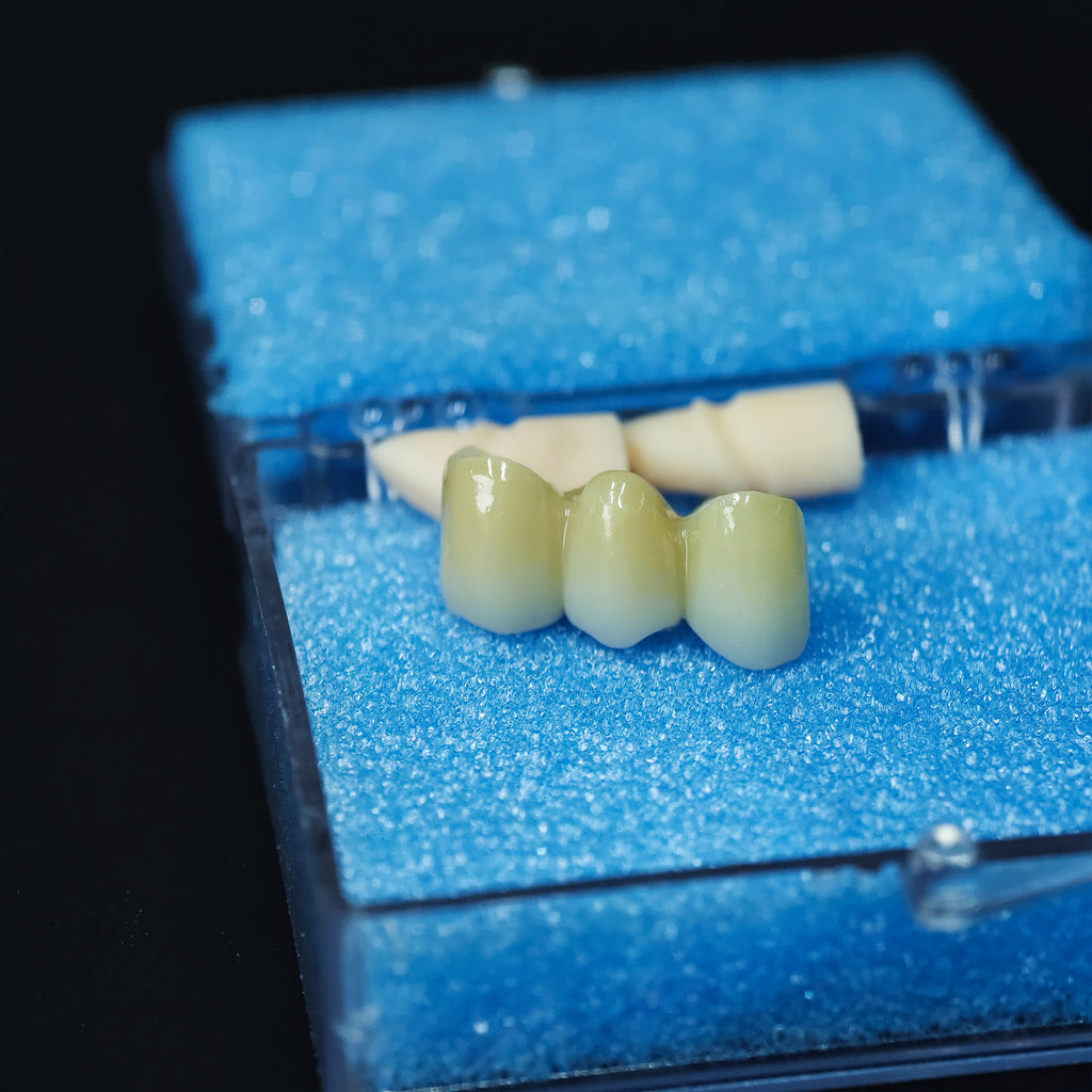 High - Strength Zirconia Bridge