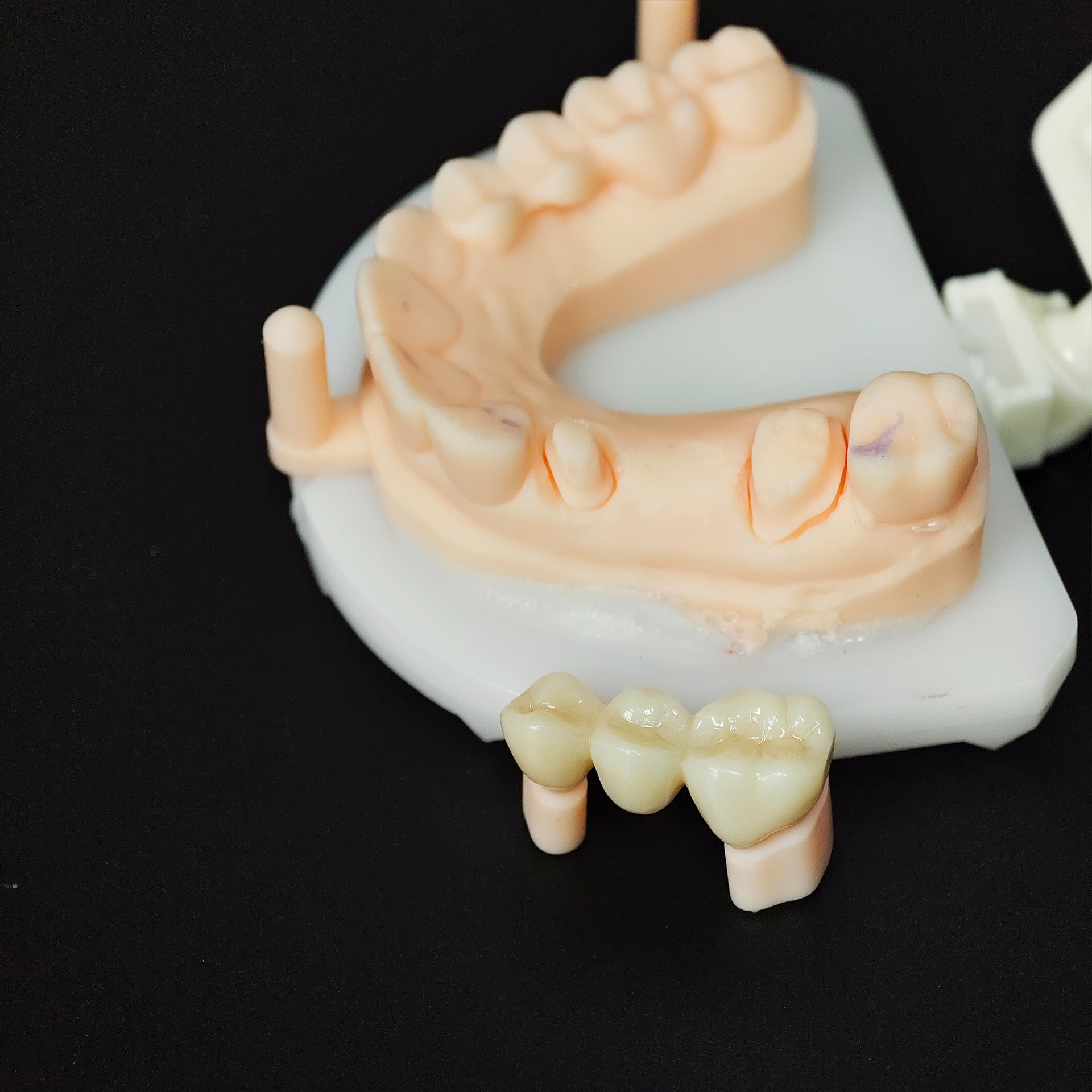 High - Strength Zirconia Bridge
