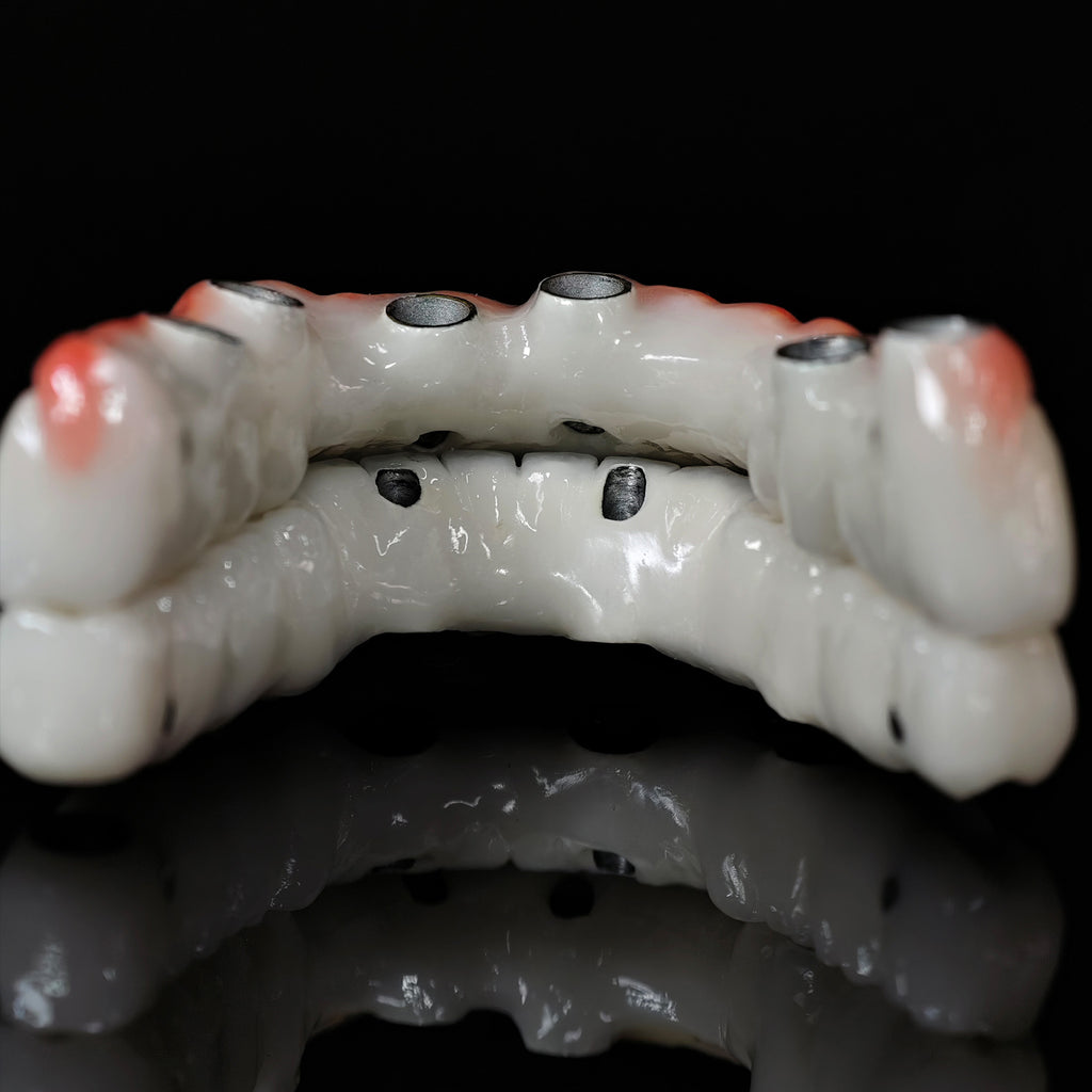Implant-supported Co - Cr PFM Dental Bridge