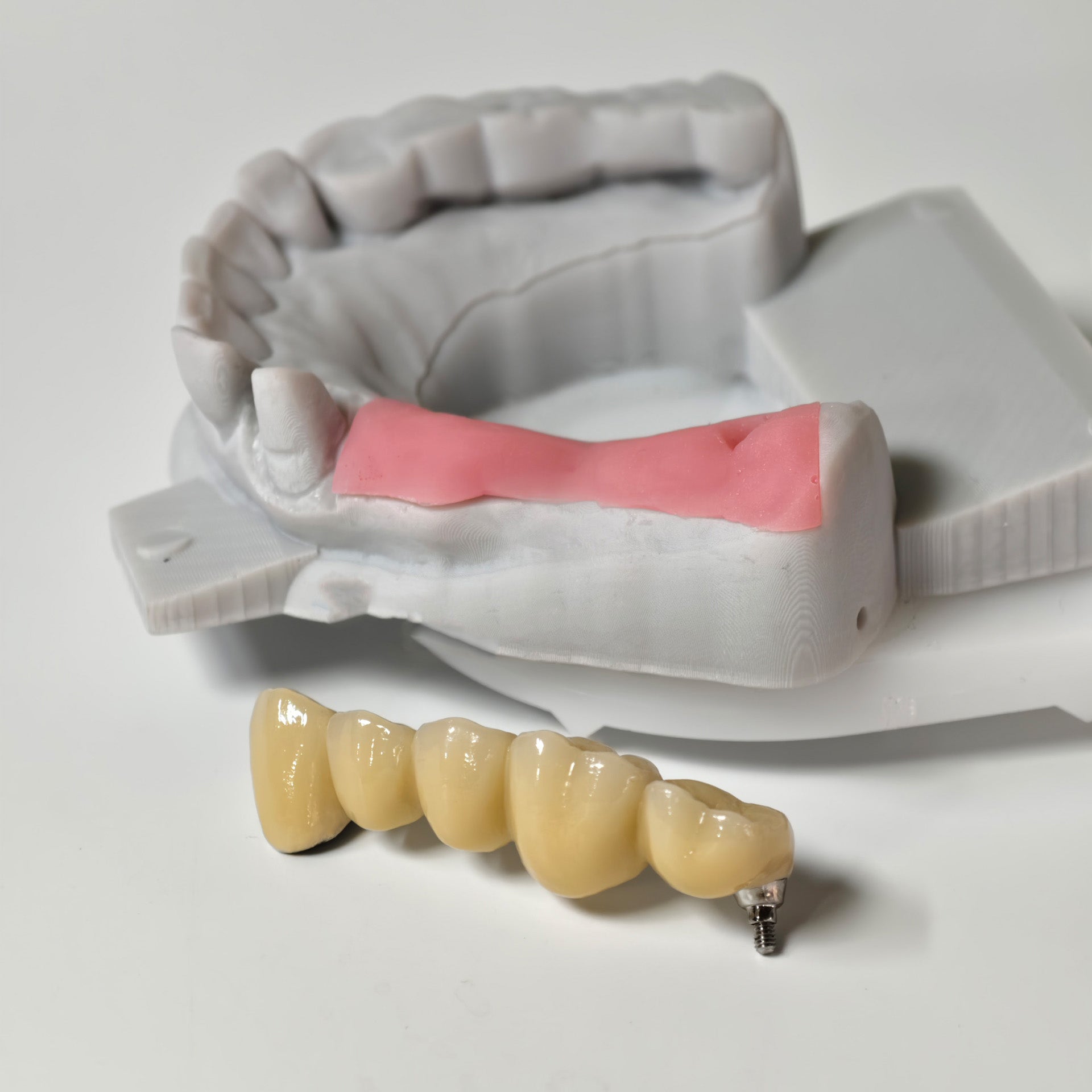 Implant-Supported PFM Single Bridge