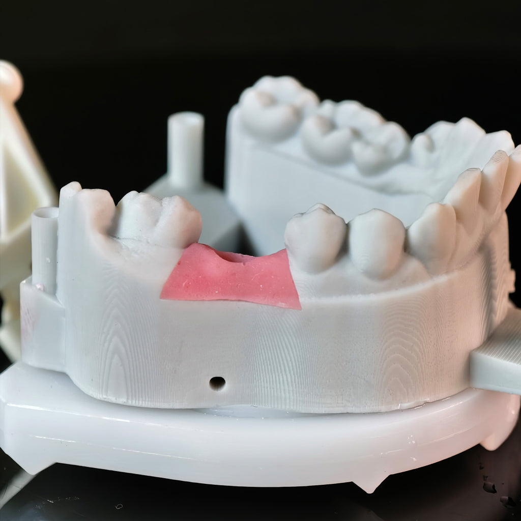 Implant-Supported PFM Single Crown