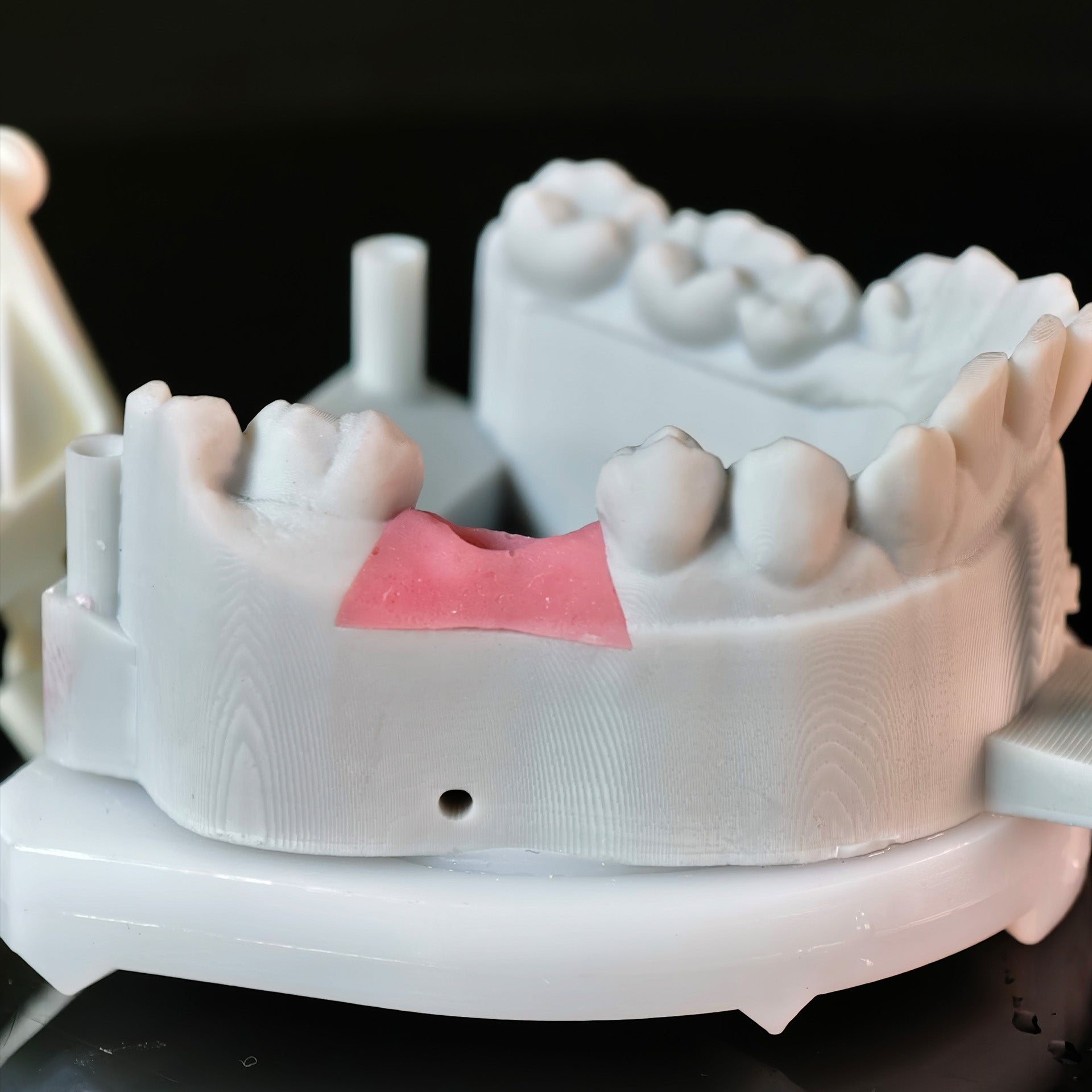Implant-Supported PFM Single Crown