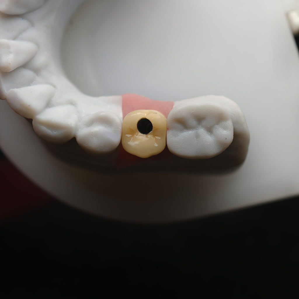 Implant-Supported PFM Single Crown