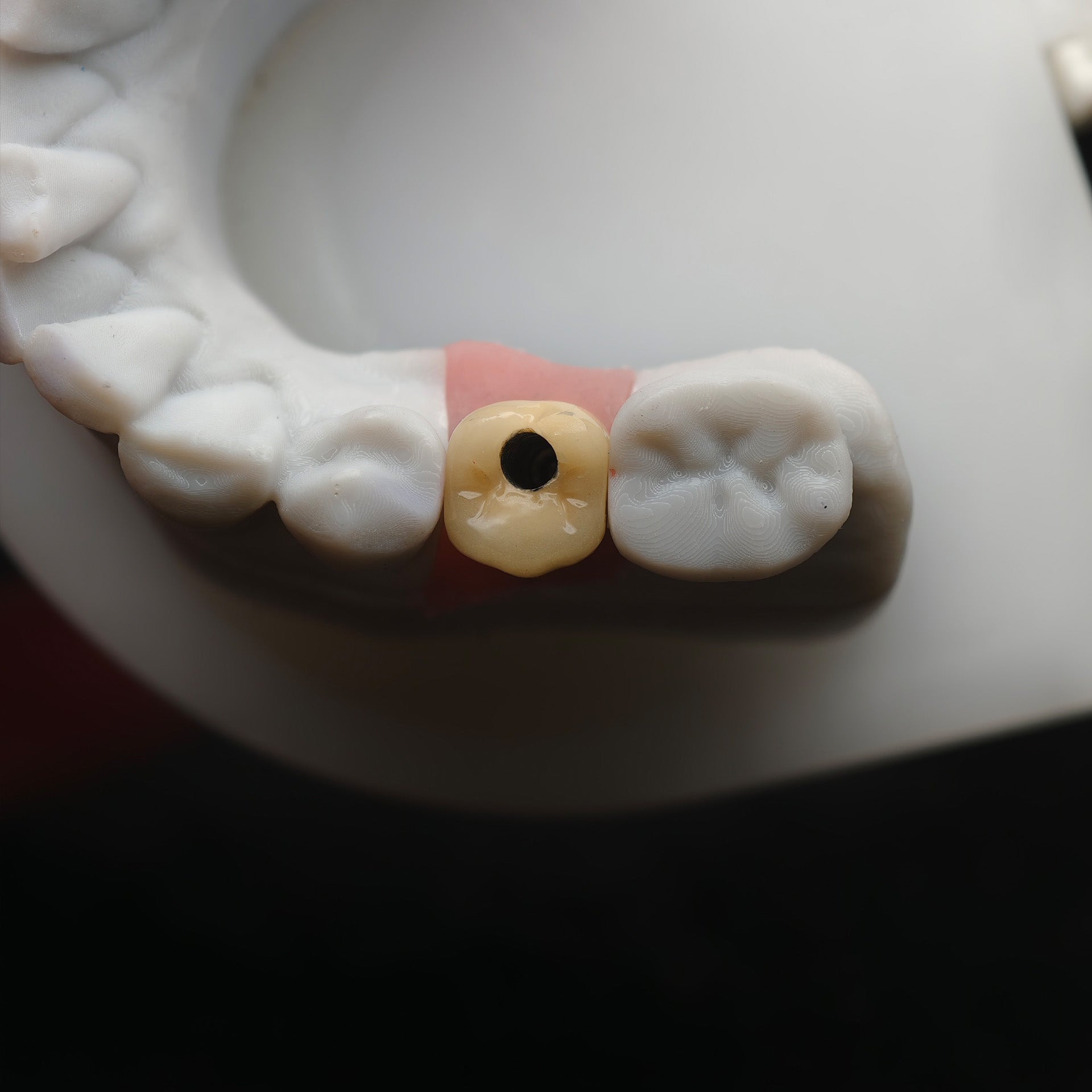 Implant-Supported PFM Single Crown