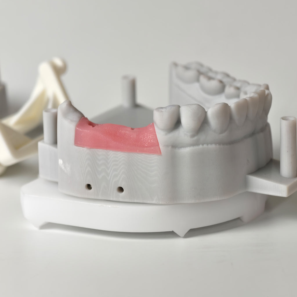 Implant-Supported PFM Single Crowns