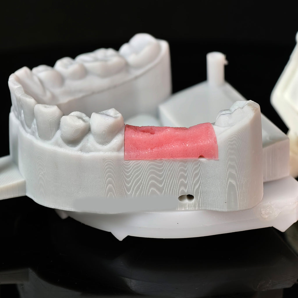 Implant-Supported PFM Single Crowns