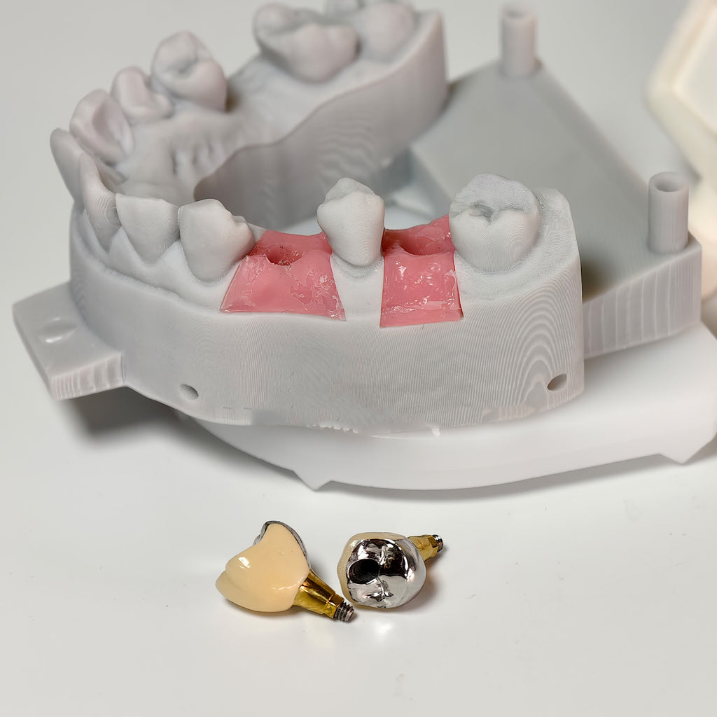 Implant-Supported PFM Single Crowns With Metal