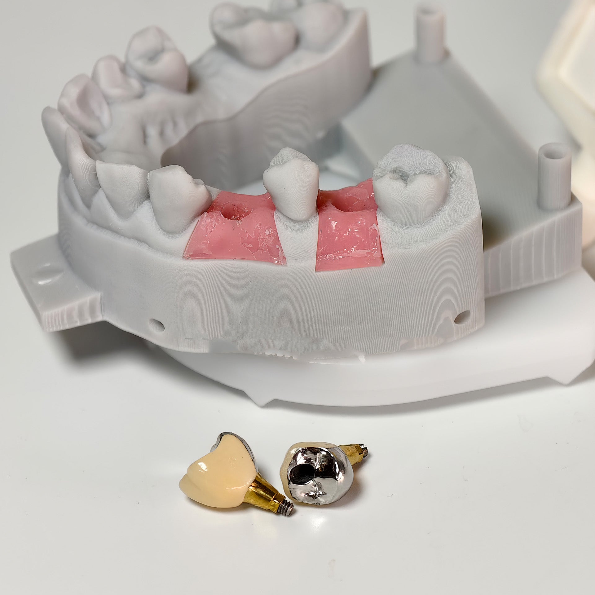 Implant-Supported PFM Single Crowns With Metal