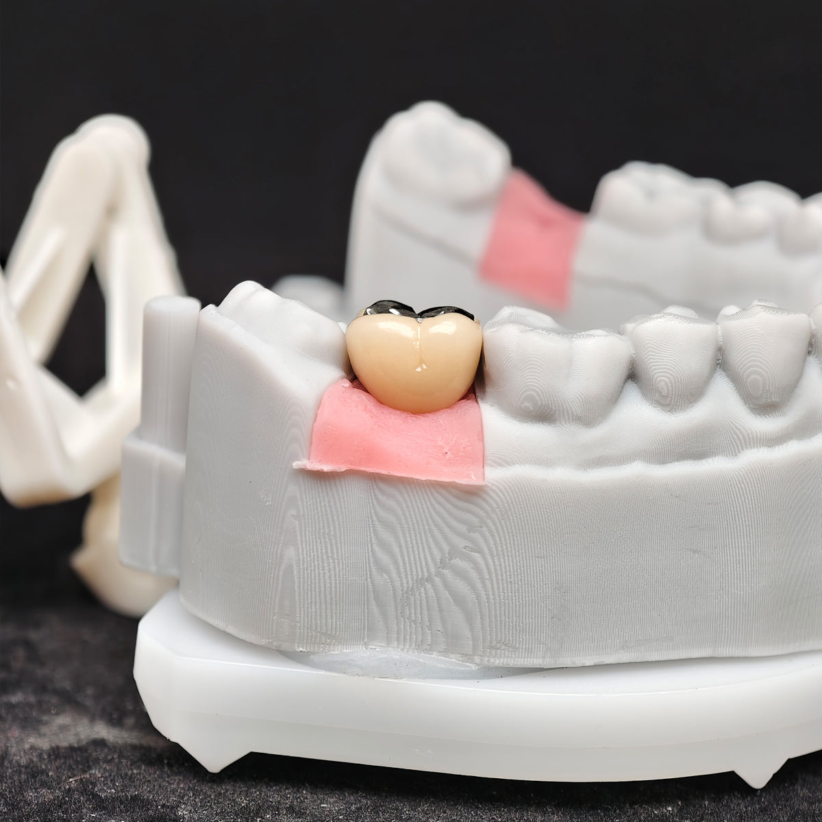 Implant-Supported PFM Single Crown With Metal