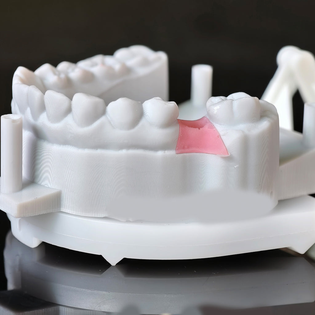 Implant-Supported PFM Single Crown With Metal