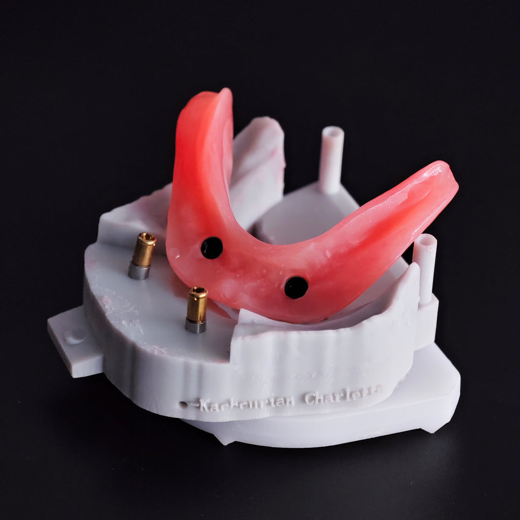 Locator Overdenture Implant Acrylic Denture Restoration